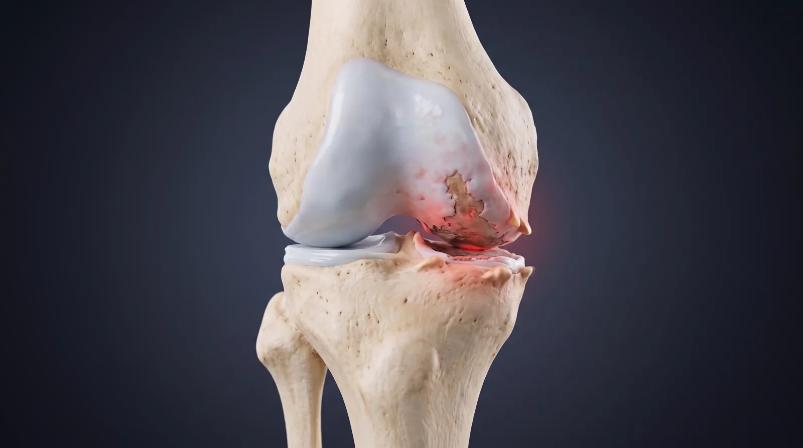 Knee osteoarthritis: worn cartilage, a narrowed joint space and bony spurs on one side of the knee — Illustrative image